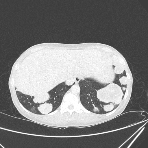 Canonball lung metastasis (Radiopaedia 77634-89837 Axial lung window 154).jpg