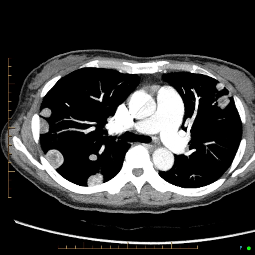 Canonball lung metastasis (Radiopaedia 77634-89837 B 38).jpg