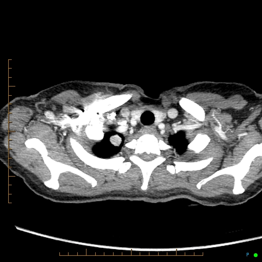 Canonball lung metastasis (Radiopaedia 77634-89837 B 4).jpg