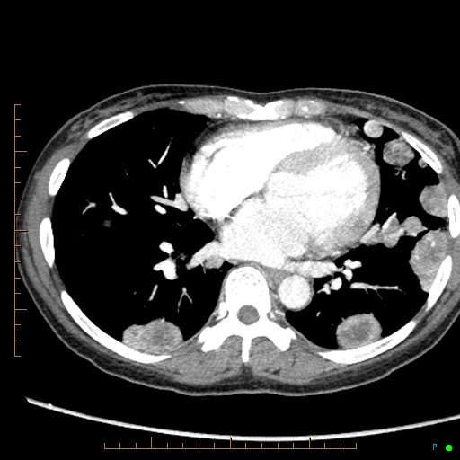 File:Canonball lung metastasis (Radiopaedia 77634-89837 B 59).jpg