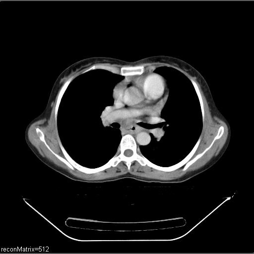 File:Carcinoma of esophagus (Radiopaedia 27356-27550 A 19).jpg