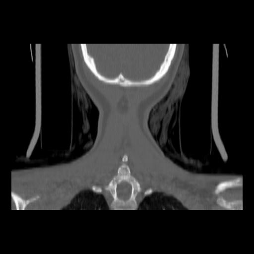 Carcinoma of the maxillary antrum (Radiopaedia 53805-59888 Coronal bone window 140).jpg