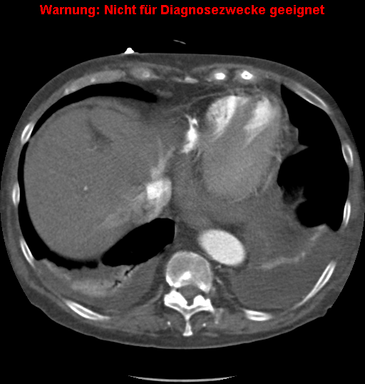 File:Cardiac perforation following transcatheter aortic valve implantation (Radiopaedia 23714-23863 A 15).png