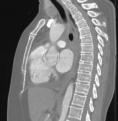 Cardiac sarcoidosis (Radiopaedia 74548-85534 Sagittal lung window 46).jpg