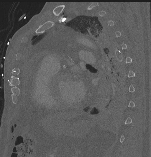 Cardiac trauma (Radiopaedia 32874-33858 Sagittal bone window 12).jpg