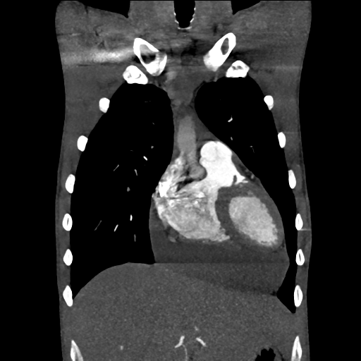 Cardiac tumor - undifferentiated pleomorphic sarcoma (Radiopaedia 45844-50134 Coronal non-contrast 18).png