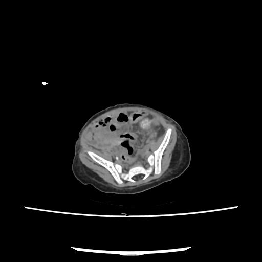File:Caroli disease with autosomal recessive polycystic kidney disease (ARPKD) (Radiopaedia 89651-106703 E 192).jpg
