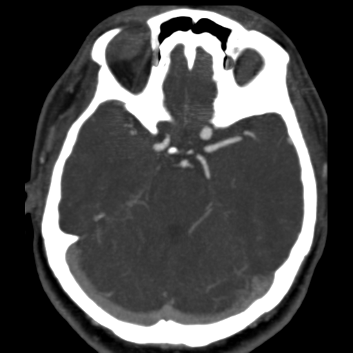 File:Carotico ophthalmic aneurysm (Radiopaedia 42916-46148 C 5).png