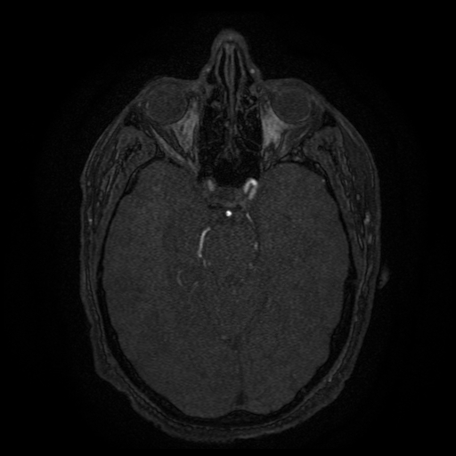 Carotid arterial dissection with acute cerebral infarction (Radiopaedia 26636-26784 MRA 107).jpg