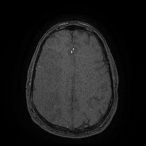 Carotid arterial dissection with acute cerebral infarction (Radiopaedia 26636-26784 MRA 39).jpg
