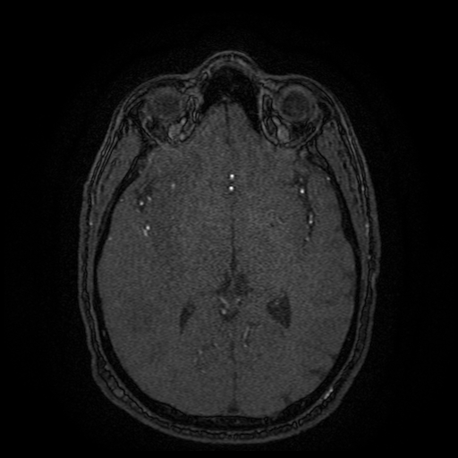 Carotid arterial dissection with acute cerebral infarction (Radiopaedia 26636-26784 MRA 81).jpg