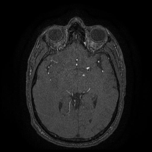 Carotid arterial dissection with acute cerebral infarction (Radiopaedia 26636-26784 MRA 88).jpg