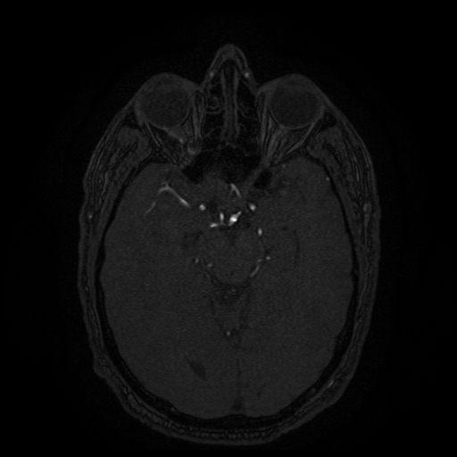 Carotid arterial dissection with acute cerebral infarction (Radiopaedia 26636-26784 MRA 97).jpg