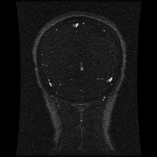 File:Carotid arterial dissection with acute cerebral infarction (Radiopaedia 26636-26784 MRV 57).jpg