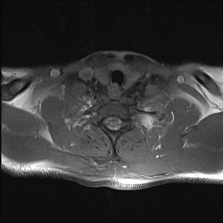 File:Carotid artery dissection (Radiopaedia 28441-28689 Axial T1 fat sat 8).jpg