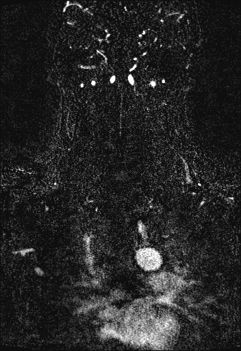 Carotid artery dissection (Radiopaedia 28441-28689 Coronal MRA 72).jpg