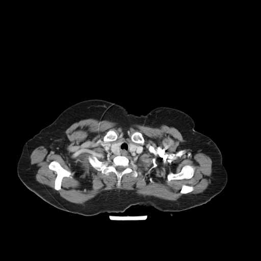 File:Carotid body tumor (Radiopaedia 21021-20948 B 23).jpg