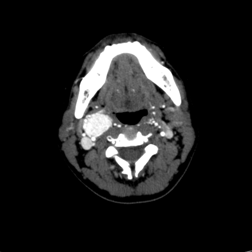File:Carotid body tumor (Radiopaedia 39845-42300 B 44).jpg