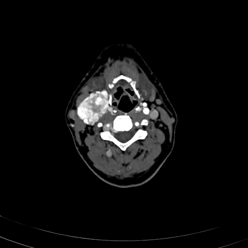 Carotid body tumor (Radiopaedia 83615-98727 A 59).jpg