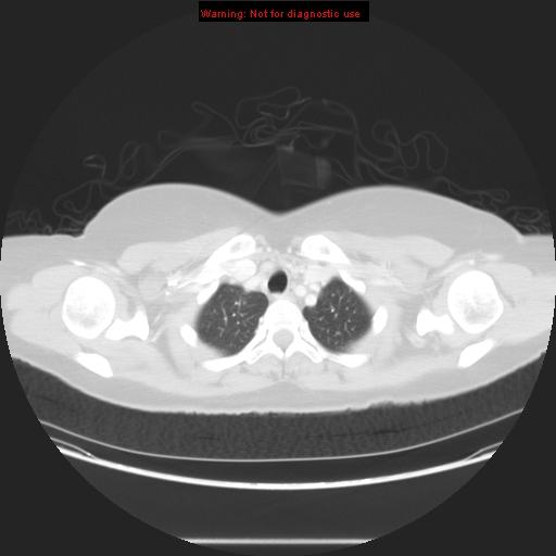 Carotid body tumor with lung metastases (Radiopaedia 9301-48390 Axial lung window 15).jpg