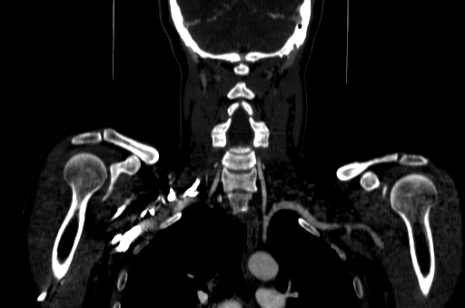 File:Carotid bulb pseudoaneurysm (Radiopaedia 57670-64616 D 63).jpg