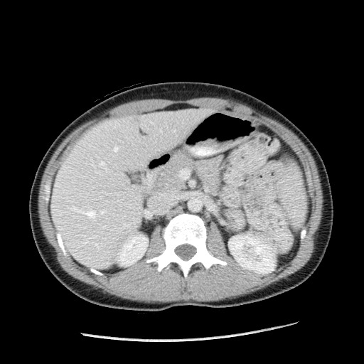 Castleman disease with fibrous pseudotumor in the abdomen (Radiopaedia 77296-89373 A 41).jpg