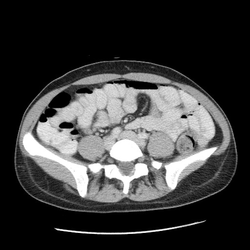 File:Castleman disease with fibrous pseudotumor in the abdomen (Radiopaedia 77296-89373 Axial 18).jpg