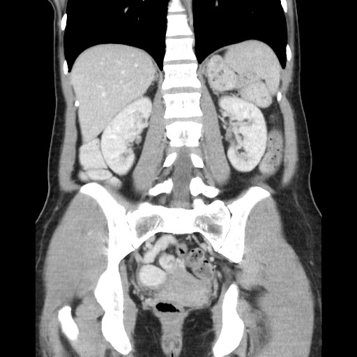 Castleman disease with fibrous pseudotumor in the abdomen (Radiopaedia 77296-89373 B 63).jpg