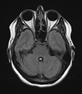 File:Cavernoma with bleed - midbrain (Radiopaedia 54546-60774 Axial FLAIR 10).png