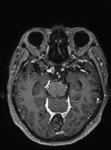 File:Cavernous hemangioma of the cerebellar falx (Radiopaedia 73025-83724 Axial T1 C+ 209).jpg