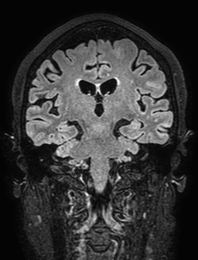 Cavernous hemangioma of the cerebellar falx (Radiopaedia 73025-83724 Coronal FLAIR 199).jpg