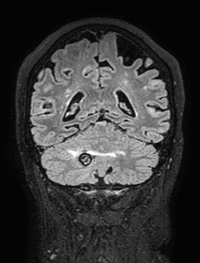 Cavernous hemangioma of the cerebellar falx (Radiopaedia 73025-83724 Coronal FLAIR 251).jpg