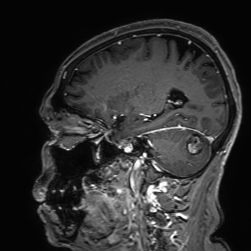 Cavernous hemangioma of the cerebellar falx (Radiopaedia 73025-83724 Sagittal T1 C+ 73).jpg