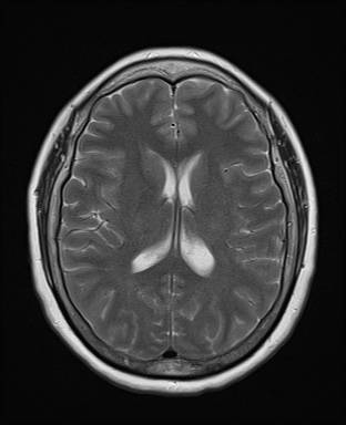 File:Cavernous sinus meningioma (Radiopaedia 63682-72367 Axial T2 14).jpg