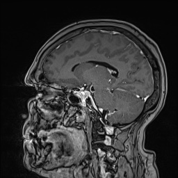 Cavernous sinus meningioma (Radiopaedia 63682-72367 Sagittal T1 C+ 103).jpg