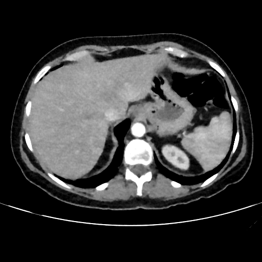 File:Cavitating lung mass - squamous cell carcinoma (Radiopaedia 48047-52854 B 41).png