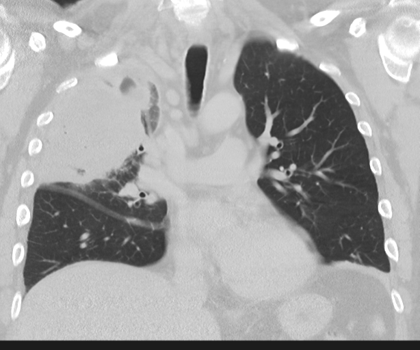 Cavitating pneumonia (Radiopaedia 45998-50329 Coronal lung window 24).png