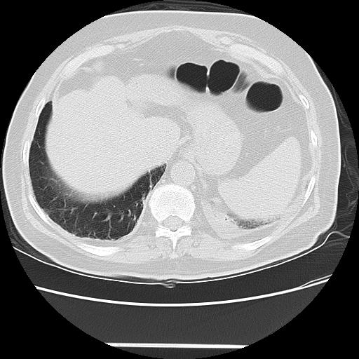 File:Cavitating pulmonary metastases (Radiopaedia 89545-106544 Axial lung window 49).jpg
