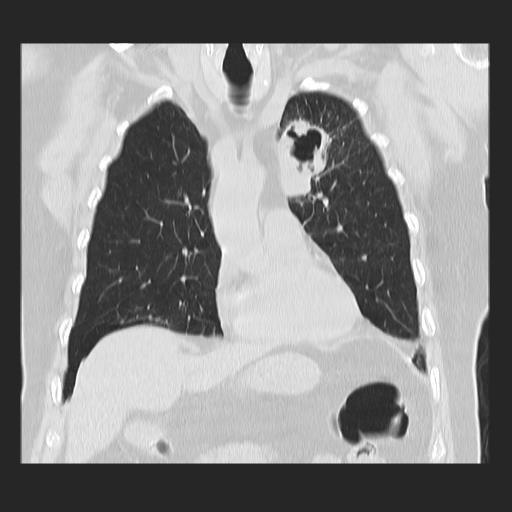 File:Cavitating pulmonary metastases (Radiopaedia 89545-106544 Coronal lung window 14).jpg