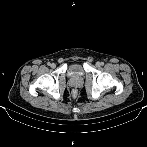 Cecal adenocarcinoma (Radiopaedia 85324-100916 Axial C+ delayed 99).jpg