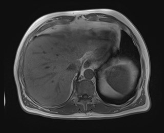 File:Cecal mass causing appendicitis (Radiopaedia 59207-66532 Axial T1 in-phase 28).jpg