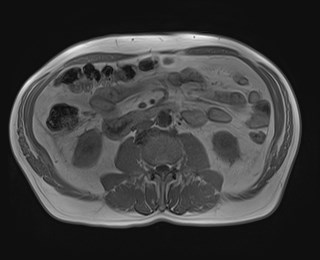 Cecal mass causing appendicitis (Radiopaedia 59207-66532 Axial T1 in-phase 72).jpg