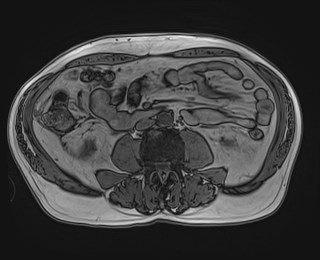 Cecal mass causing appendicitis (Radiopaedia 59207-66532 D 77).jpg