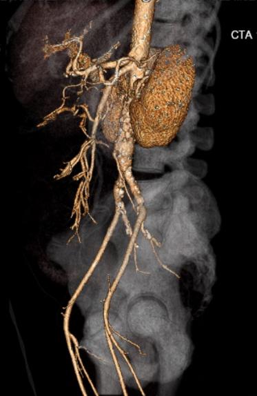 File:Celiac artery severe stenosis and dissection (Radiopaedia 44128-47842 C+ arterial phase 23).jpg