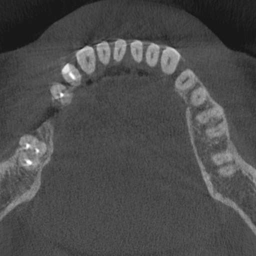 Cemento-osseous dysplasia (Radiopaedia 48251-53126 Axial non-contrast 47).jpg
