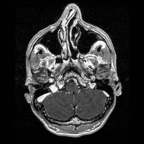 Central-variant posterior reversible encephalopathy syndrome (PRES) (Radiopaedia 43880-47358 Axial T1 C+ 19).jpg