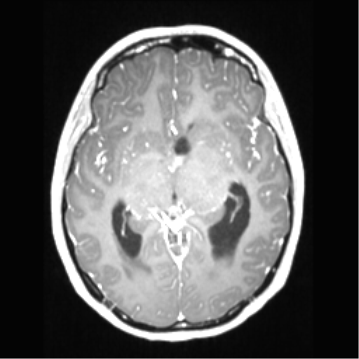 Central neurocytoma (Radiopaedia 37664-39557 Axial T1 C+ 37).png