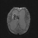 Central neurocytoma (Radiopaedia 56690-63469 Axial DWI 31).jpg