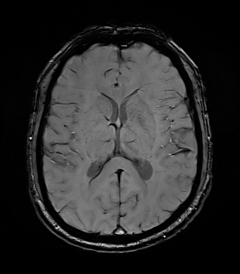File:Central neurocytoma (Radiopaedia 71068-81303 Axial SWI 35).jpg