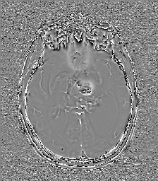 Central neurocytoma (Radiopaedia 84497-99872 Axial 34).jpg